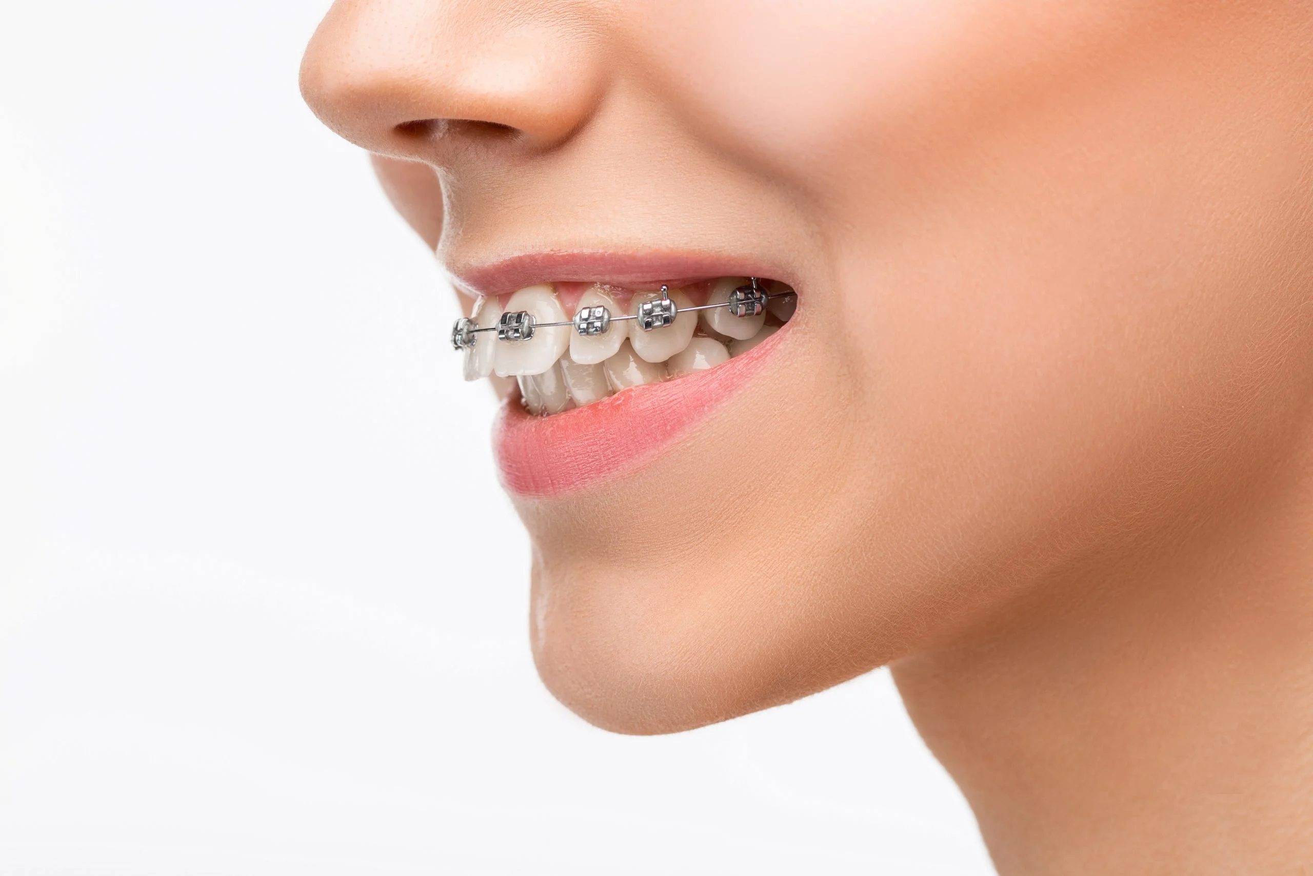 Bracket | klinikmydentist.com